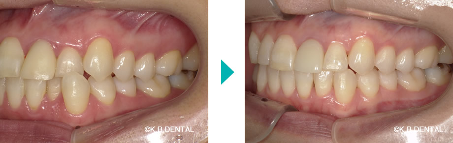 左側：叢生治療例