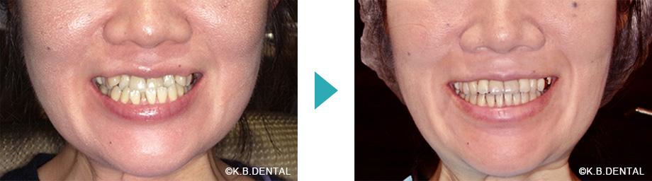 顔貌：叢生治療例