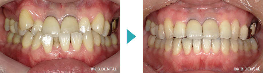 正面：叢生治療例