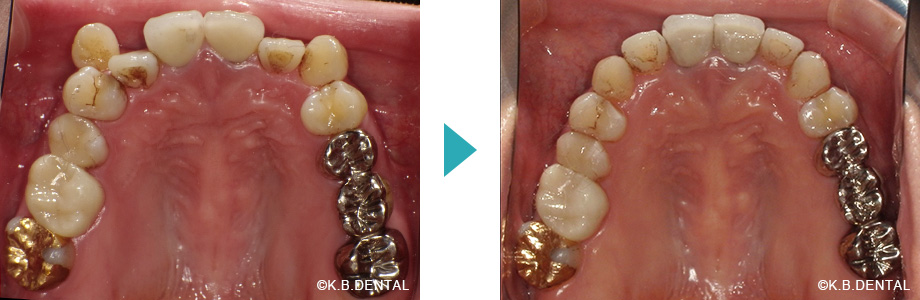 上顎：叢生治療例