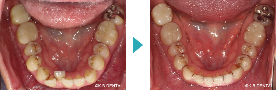 下顎：叢生治療例