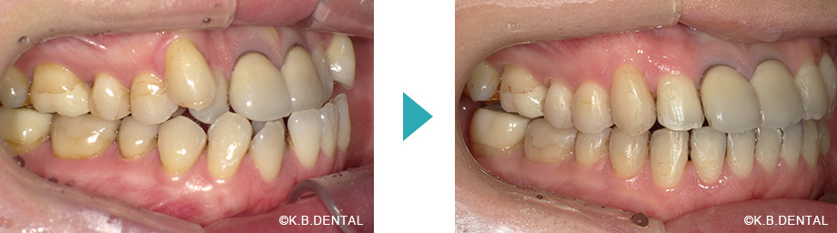 右側：叢生治療例