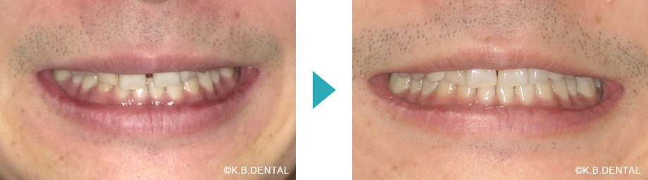 顔貌：正中離開治療例