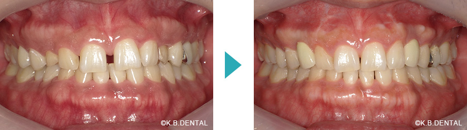 正面：正中離開治療例
