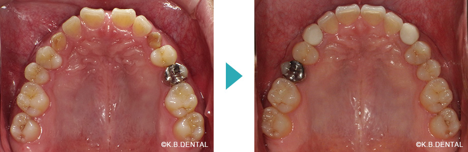 上顎：正中離開治療例