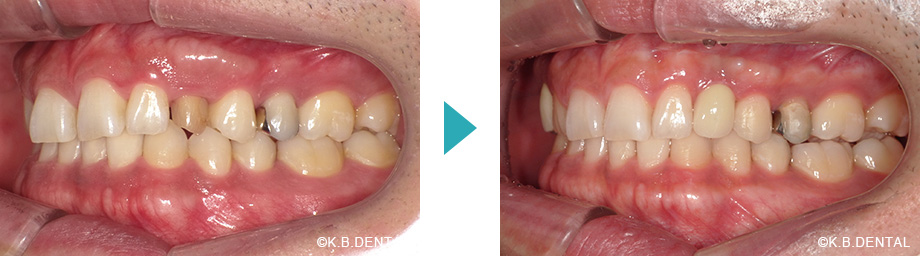 左側：正中離開治療例