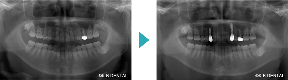 レントゲン：正中離開治療例