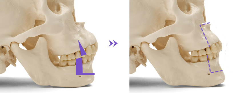 口ゴボ・上下顎前突の治療
