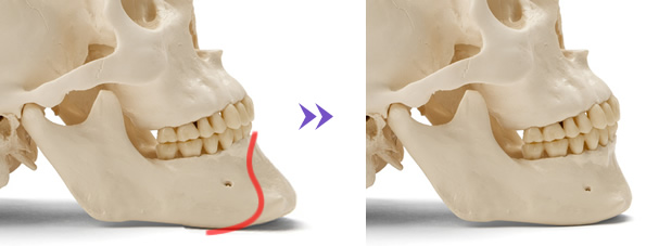 オトガイ形成手術