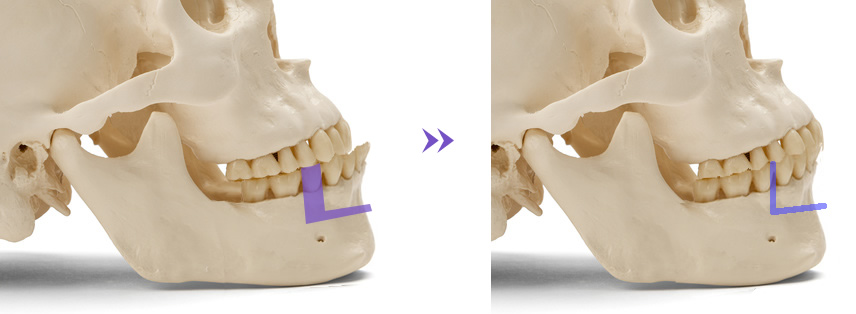 下顎前方歯槽骨骨切り術