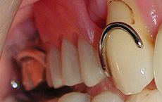 入れ歯の留め金