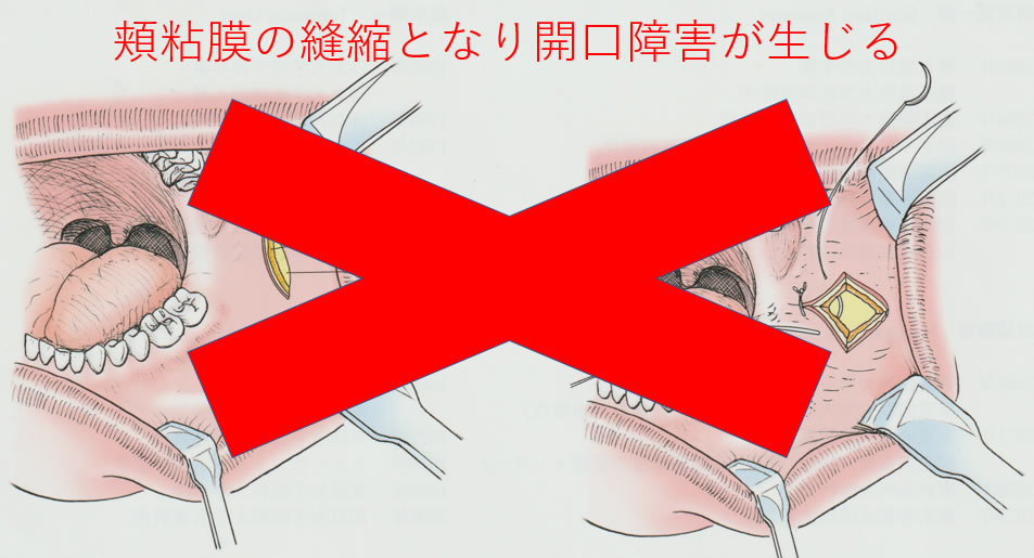 頬粘膜の縫縮となり開口障害