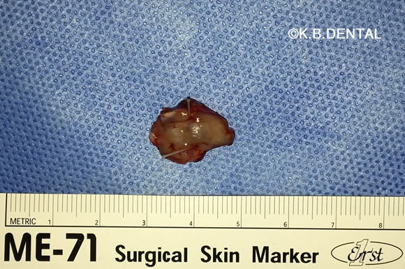 扁平苔癬摘出物