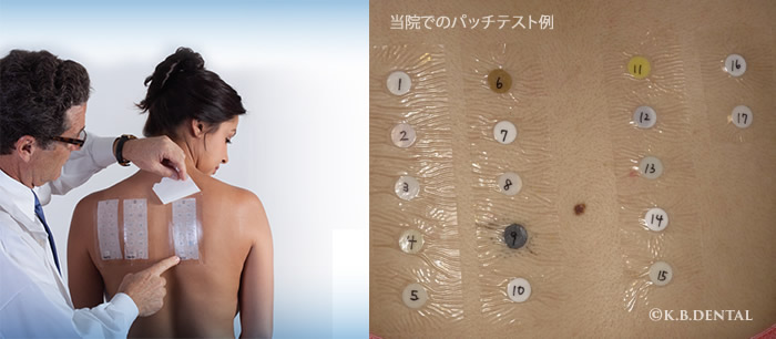 金属アレルギーパッチテスト