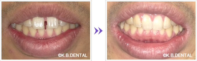 口元：すきっ歯