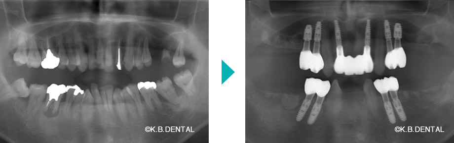 パノラマ：嘔吐反射症例