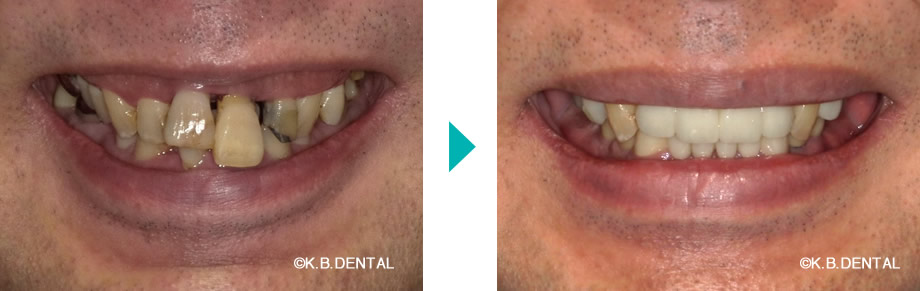 口元：嘔吐反射症例