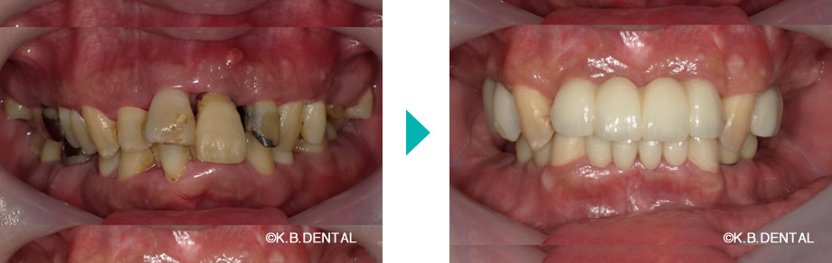口腔内：嘔吐反射症例