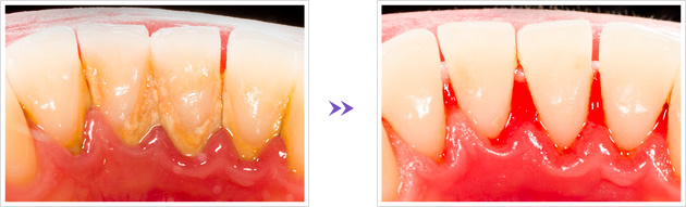 歯石除去術前術後