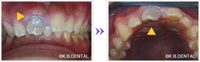 前歯：鼻口蓋管嚢胞
