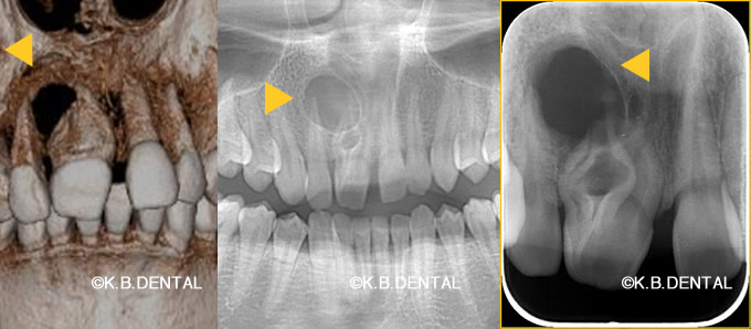 CT・レントゲン：鼻口蓋管嚢胞