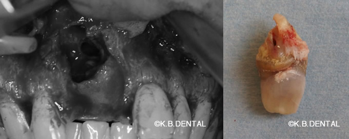 摘出：鼻口蓋管嚢胞