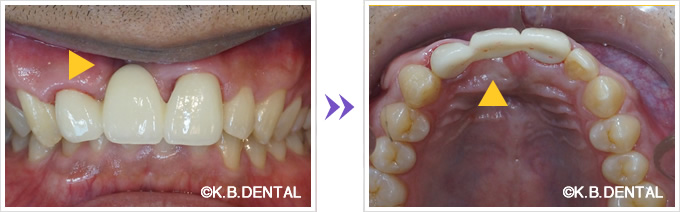 術後：鼻口蓋管嚢胞