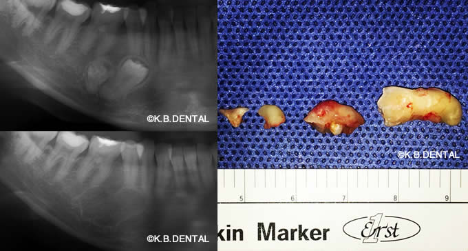 歯牙腫摘出・埋伏歯抜歯