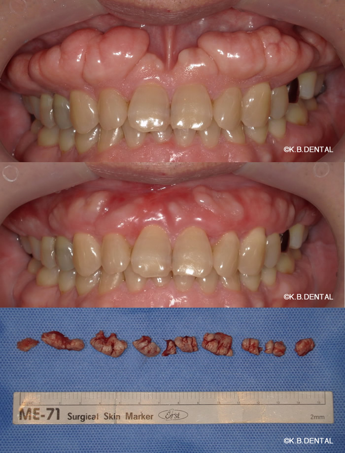 上顎外側骨隆起
