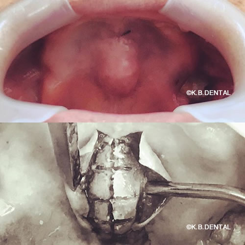 口蓋隆起骨摘出