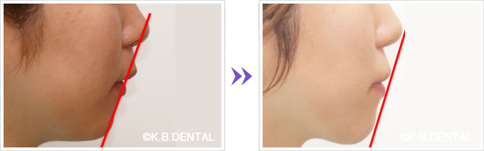 顔貌：類表皮嚢胞術