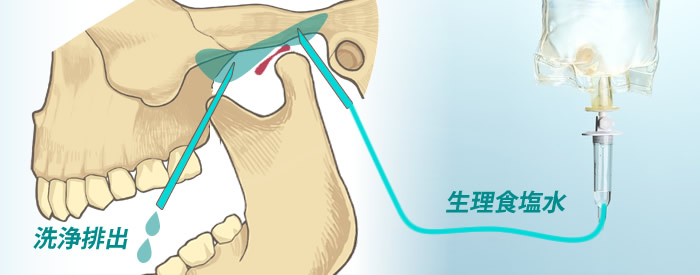 顎関節腔の洗浄